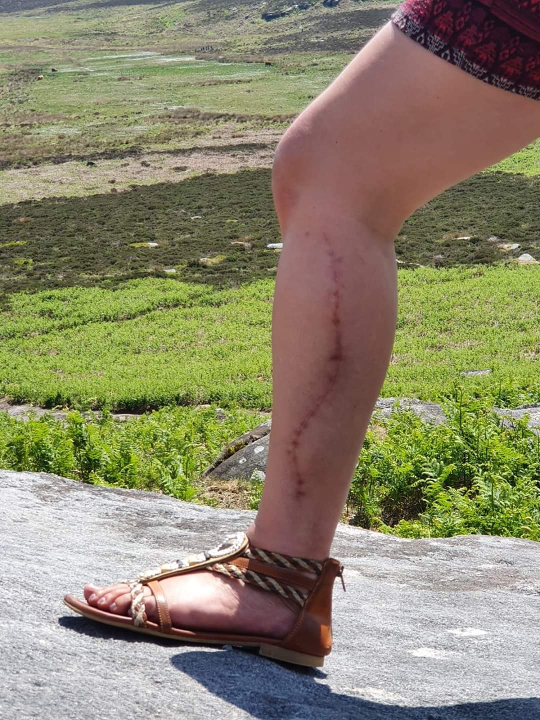 Gill leg scar