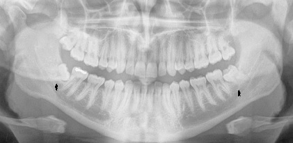 A Biased View of Wisdom Teeth Growing In