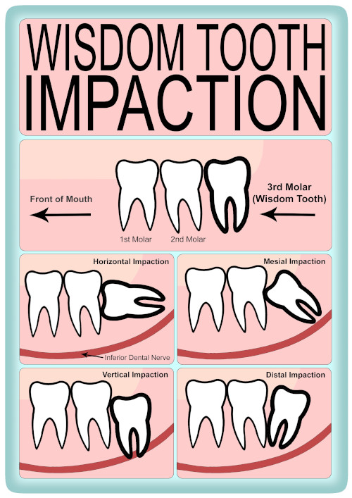 Removal of Impacted Wisdom Teeth. impacted wisdom teeth tinnitus. 