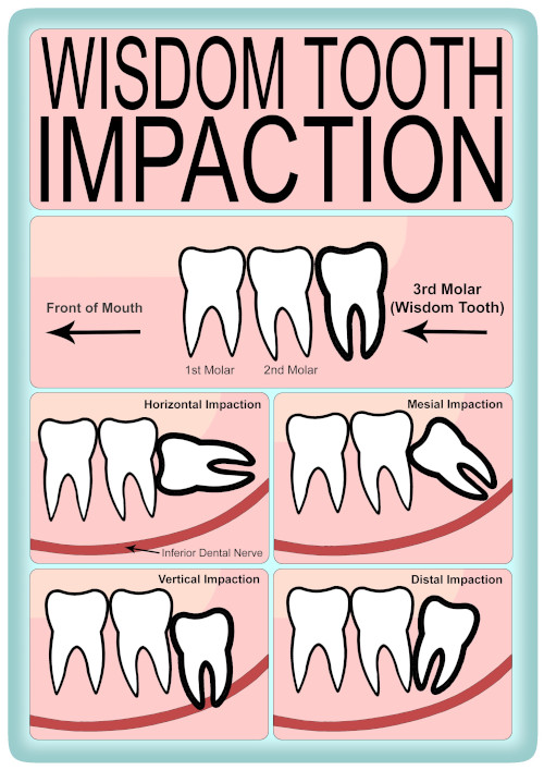 Melbourne Wisdom Teeth