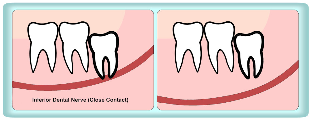 Removal Of Impacted Wisdom Teeth British Association Of Oral And Maxillofacial Surgeons